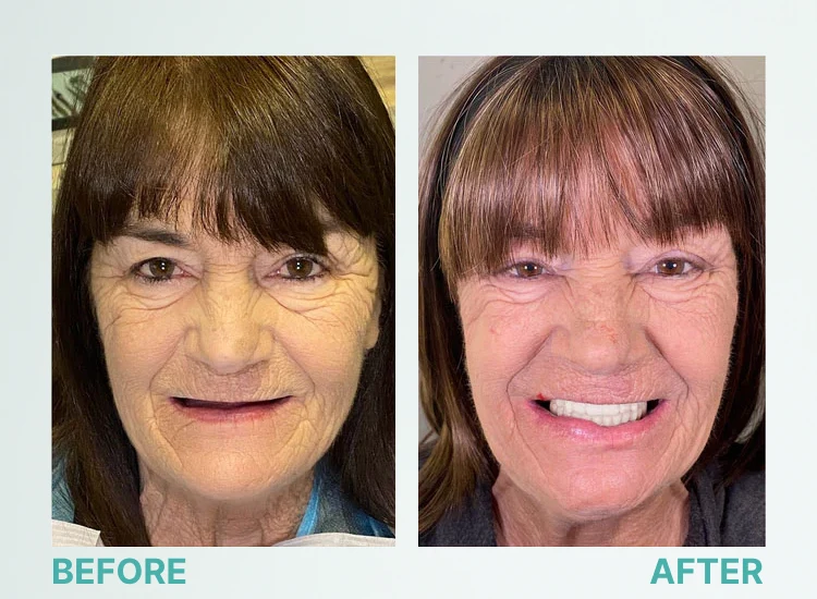 Natural Smile Full Denture Set (Upper & Lower)