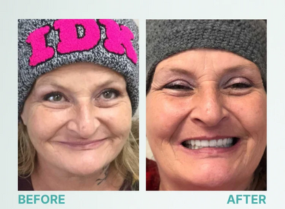 Natural Smile Full Denture Set (Upper & Lower)